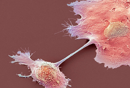 Image: Colored scanning electron micrograph (SEM) of pancreatic cancer cells (photo courtesy Steve Gschmeissner / Science Photo Library).